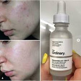 The Ordinary Niacinamide 10% + Zinc 1 % – 30ml |oil Control, Pore Minimizing & Blemish Solution Serum|